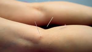 acupunctuur voor afvallen